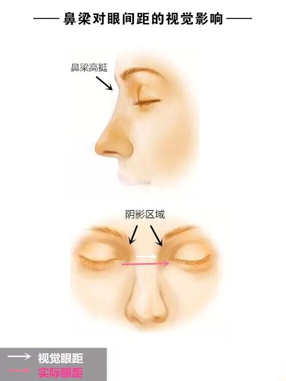假体隆鼻需要定期更换吗？