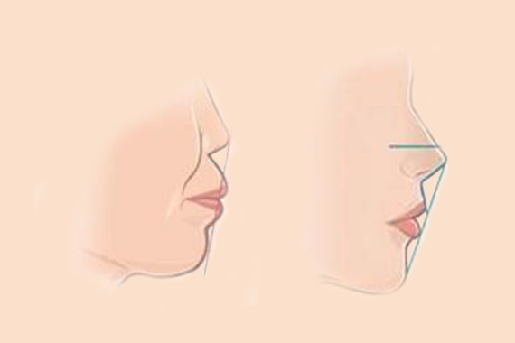 厚唇改薄术后需要如何护理