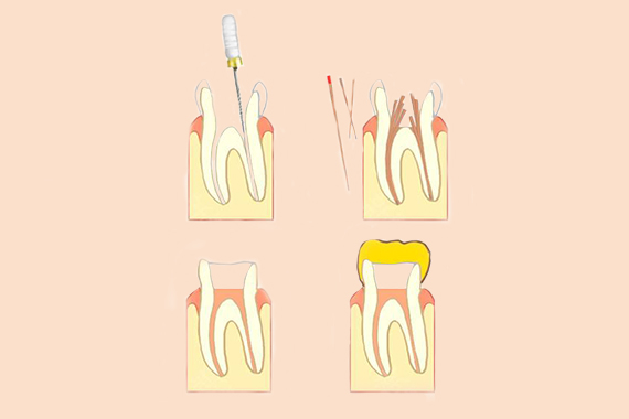 种植牙的治疗过程是什么