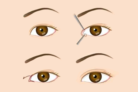 割双眼皮方法及术后护理