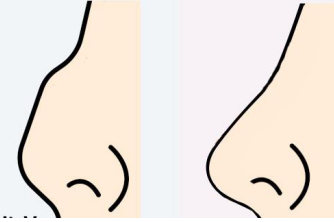 花容网：歪鼻矫正，重塑鼻子的美丽