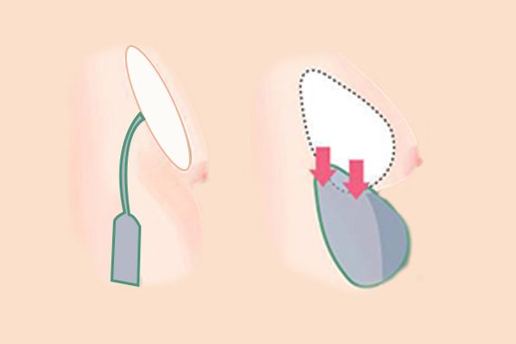 长沙尚美医疗美容门诊部如何选择适合你的隆胸方式