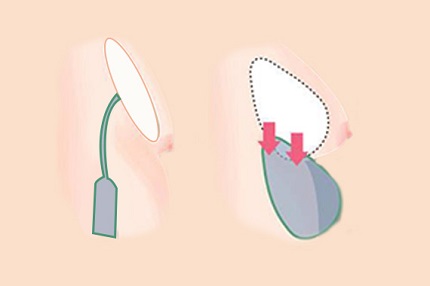 铁岭刘秀凤医疗美容诊所常用的乳头内陷矫正方法是哪些？