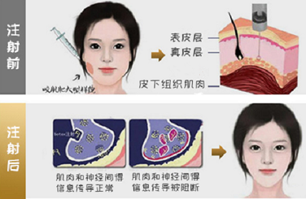 大连曹建平医疗美容诊所答瘦脸*的三个潜在副作用具体是什么？