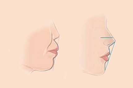 哈尔滨韩辰医疗美容门诊|唇部微整形的后遗症？
