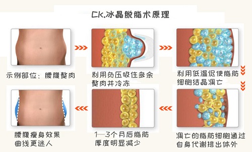  淮北市中医医院医疗整形美容中心吸脂减肥前后对比图