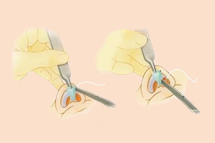 临江市玉华整形美容外科诊所|鼻翼缩小手术可能出现的风险