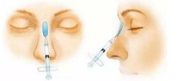 硅胶隆鼻整形术后护理注意事项，硅胶假体假体隆鼻多久能够恢复?
