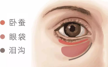 祛眼袋的术后怎么样去护理？激光微创无痕祛眼袋后眼睛是精神多了