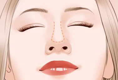 缩鼻头的手术方法有哪些？鼻头缩小后伤口怎么护理？