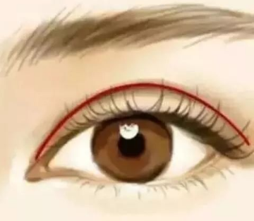双眼皮术后的护理包括哪些方面？做完双眼皮多长时间是疤痕的增生